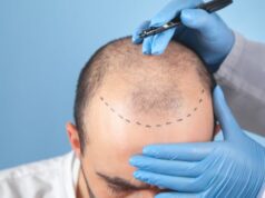 Apakah Transplantasi Rambut Benar-Benar Mengatasi Kebotakan pada Pria? Ini Penjelasan, Biaya, dan Destinasi Terbaiknya