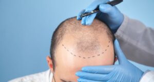 Apakah Transplantasi Rambut Benar-Benar Mengatasi Kebotakan pada Pria? Ini Penjelasan, Biaya, dan Destinasi Terbaiknya